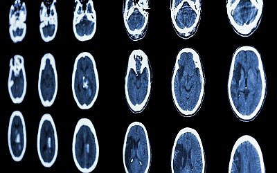 An illustrative CT scan of a brain shows ischemic stroke and hemorrhagic stroke. (stockdevil; iStock by Getty Images)